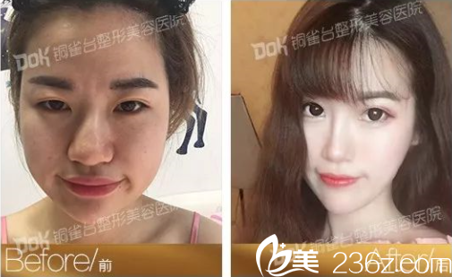 重慶銅雀臺瘦臉效果怎么樣