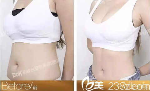 重慶銅雀臺腰腹吸脂案例