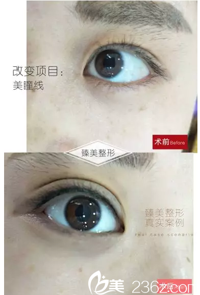 哈爾濱臻美半美瞳線真人案例