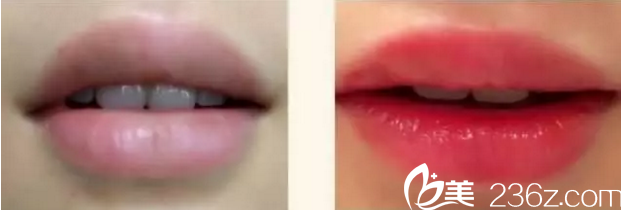 哈爾濱臻美半唇真人案例