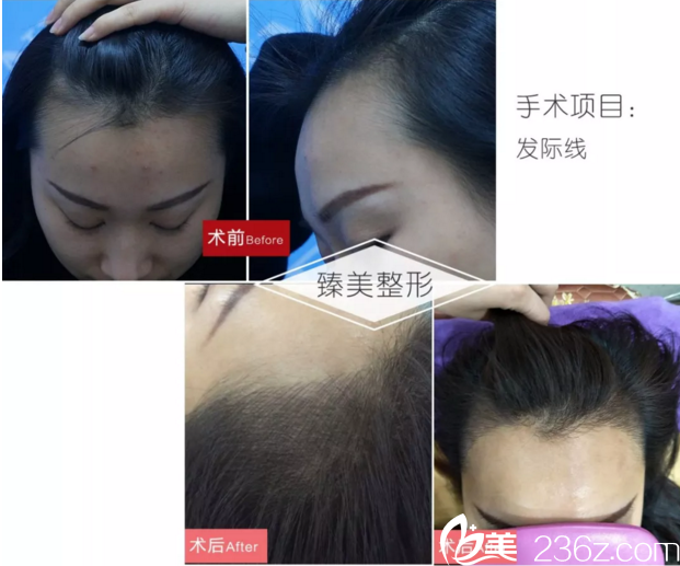 哈爾濱臻美半紋發(fā)際線真人案例