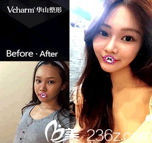 我在華山整形醫(yī)院找胡斌院長做的雙眼皮前后對比圖