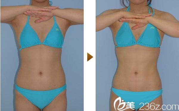 內(nèi)浦康信腹部吸脂 內(nèi)浦康信腹部吸脂