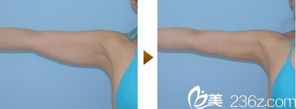 內(nèi)浦康信手臂吸脂 內(nèi)浦康信手臂吸脂