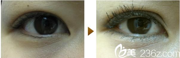 內(nèi)浦康信雙眼皮手術(shù) 內(nèi)浦康信雙眼皮手術(shù)