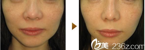 內(nèi)浦康信鼻尖縮小術(shù) 內(nèi)浦康信鼻尖縮小術(shù)