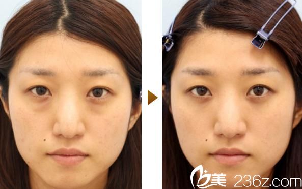 百澤明祛眼袋 百澤明祛眼袋