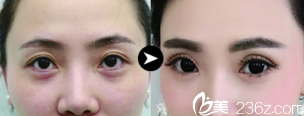 蘭州仁和葉海云雙眼皮失敗修復(fù)效果怎么樣 蘭州仁和葉海云雙眼皮失敗修復(fù)效果怎么樣