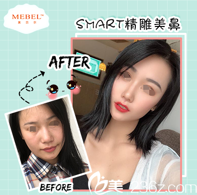 美貝爾隆鼻案例