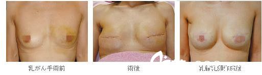 院長(zhǎng)巖平佳子乳腺癌后乳房再建 院長(zhǎng)巖平佳子乳腺癌后乳房再建