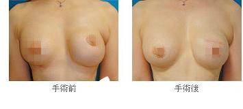 院長(zhǎng)巖平佳子乳房異位重建 院長(zhǎng)巖平佳子乳房異位重建