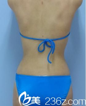 手術(shù)3個月后背面展示 手術(shù)3個月后背面展示