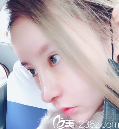 汕頭華美朱洙玉隆鼻術(shù)后7天拆線圖