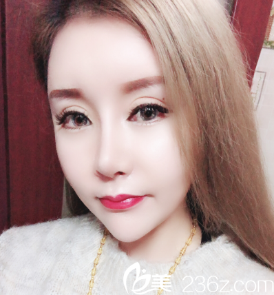 汕頭華美朱洙玉做的鼻綜合隆鼻案例