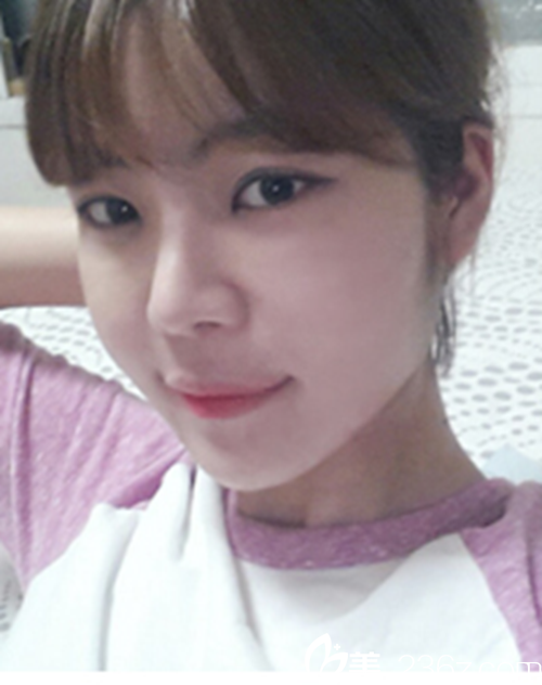 韓國新帝瑞娜醫(yī)院眼部+鼻部+脂肪填充術(shù)后1個月后