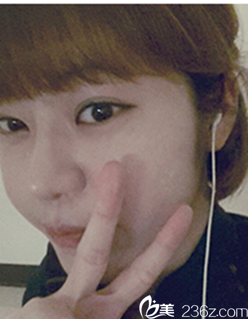 韓國新帝瑞娜醫(yī)院眼部+鼻部+脂肪填充術(shù)后1個月后