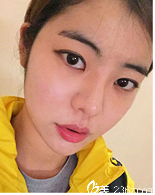 韓國新帝瑞娜醫(yī)院眼部+鼻部+脂肪填充術(shù)后3個月后