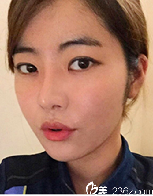 韓國新帝瑞娜醫(yī)院眼部+鼻部+脂肪填充術(shù)后3個月后