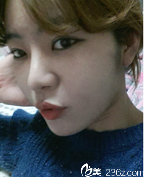 韓國新帝瑞娜醫(yī)院眼部+鼻部+脂肪填充術(shù)后5個月后