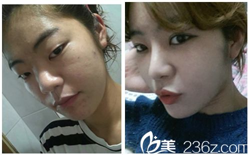 韓國新帝瑞娜醫(yī)院眼部+鼻部+脂肪填充術(shù)前術(shù)后對比圖