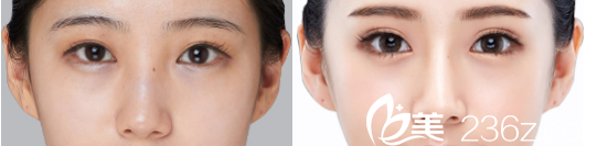 成都銅雀臺(tái)陶俊雙眼皮+隆鼻案例 成都銅雀臺(tái)陶俊雙眼皮+隆鼻案例