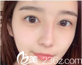 雙眼皮不對稱的我 雙眼皮不對稱的我