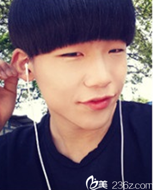 2韓國(guó)新帝瑞娜醫(yī)院鼻部+眼睛矯正術(shù)前