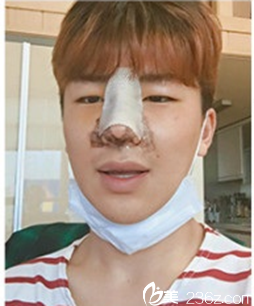 韓國(guó)新帝瑞娜醫(yī)院鼻部整形術(shù)后