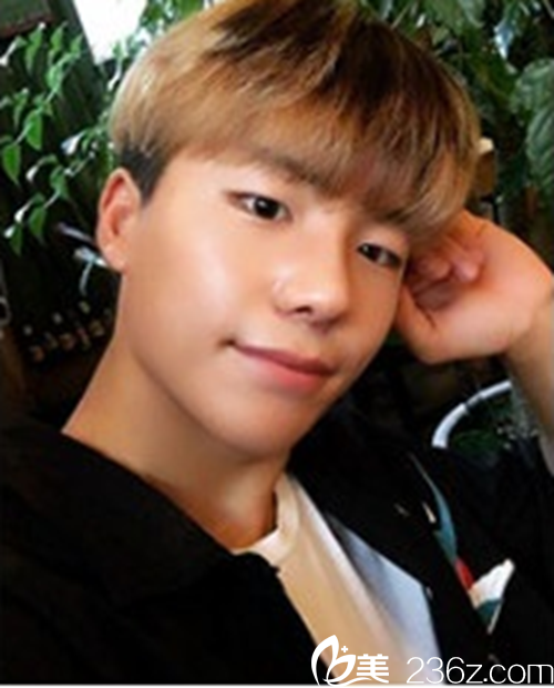 韓國(guó)新帝瑞娜醫(yī)院鼻部整形術(shù)后