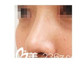 分享品川美容外科醫(yī)院線雕隆鼻經(jīng)歷，找照屋智醫(yī)生為我做的高挺鼻梁