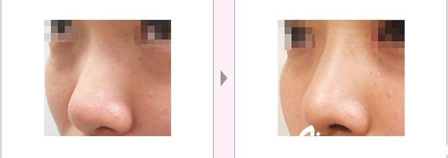 隆鼻前后對比效果 隆鼻前后對比效果
