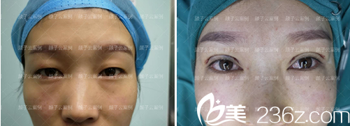 顏?zhàn)釉齐p眼皮術(shù)后即刻對比 顏?zhàn)釉齐p眼皮術(shù)后即刻對比