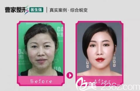 羅<!--<i data=20240703-sp></i>-->5D線雕提拉術真人前后效果對比展示 羅<!--<i data=20240703-sp></i>-->5D線雕提拉術真人前后效果對比展示