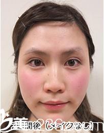 講講我在品川美容外科醫(yī)院找照屋智醫(yī)生的天然法埋線雙眼皮，真的是天然去雕飾