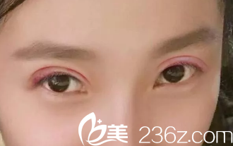 術(shù)后當(dāng)時(shí)的照片 術(shù)后當(dāng)時(shí)的照片