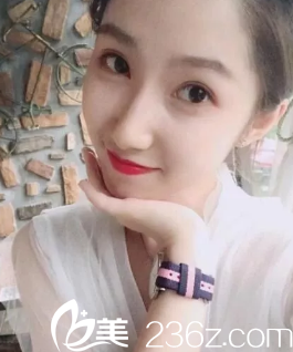 在煙臺(tái)美神做雙眼皮修復(fù)第60天 在煙臺(tái)美神做雙眼皮修復(fù)第60天