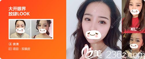 武漢美基元雙眼皮真人案例 武漢美基元雙眼皮真人案例