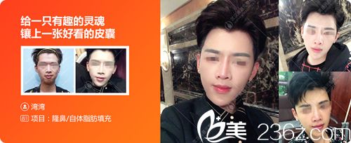 武漢美基元隆鼻+自體脂肪面部填充案例 武漢美基元隆鼻+自體脂肪面部填充案例