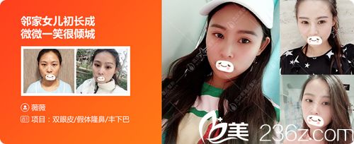 武漢美基元豐下巴真人案例 武漢美基元豐下巴真人案例