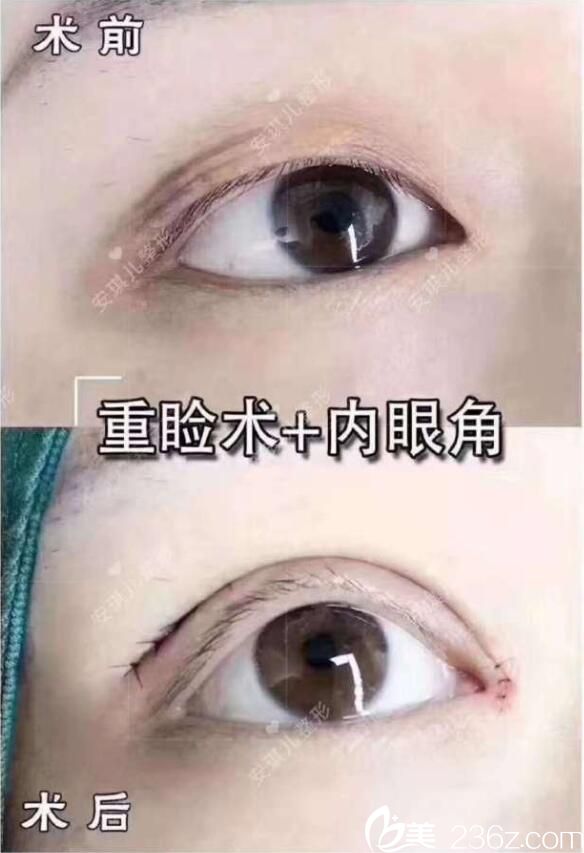 十堰安琪兒雙眼皮對比案例 十堰安琪兒雙眼皮對比案例