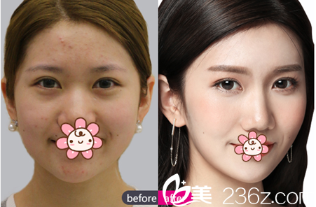 成都銅雀臺(tái)玻尿酸隆鼻案例 成都銅雀臺(tái)玻尿酸隆鼻案例