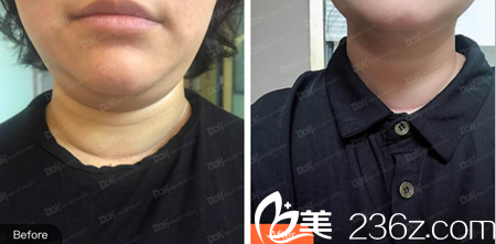 成都銅雀臺(tái)金可消除雙下巴治療效果 成都銅雀臺(tái)金可消除雙下巴治療效果