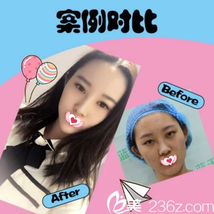 黃瑞興自體脂肪填充全面術(shù)真人前后效果對(duì)比