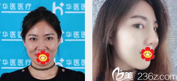 華醫(yī)高青華割雙眼皮隆鼻效果案例