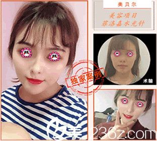 南京美貝爾整形醫(yī)院案例