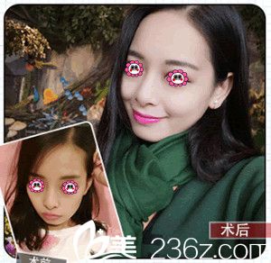 美貝爾整形醫(yī)院自體脂肪面部填充變化圖