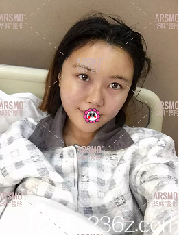 余恩旭醫(yī)生給我做面部脂肪填充天樣子