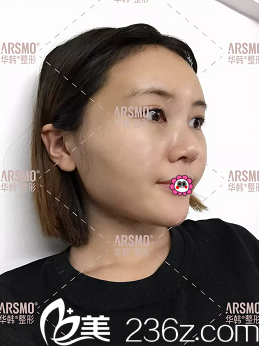 北京華韓余恩旭自體脂肪面部填充