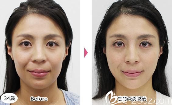 照屋智埋線提升前后對比