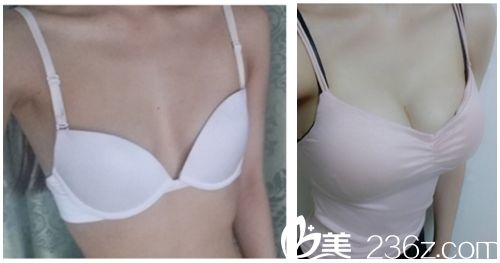 胸部整形術(shù)前術(shù)后對(duì)比圖 胸部整形術(shù)前術(shù)后對(duì)比圖